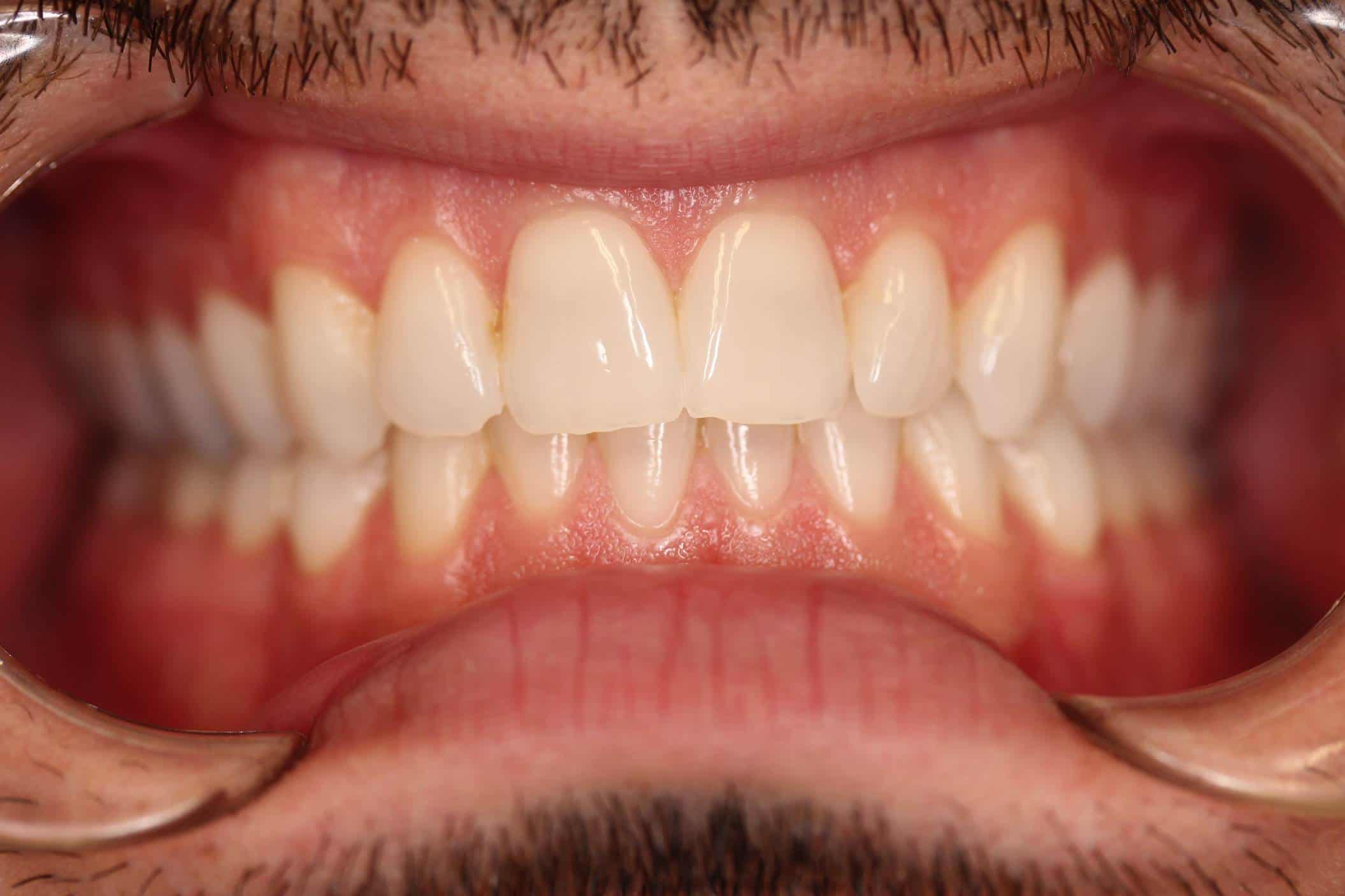 before whitening teeth
