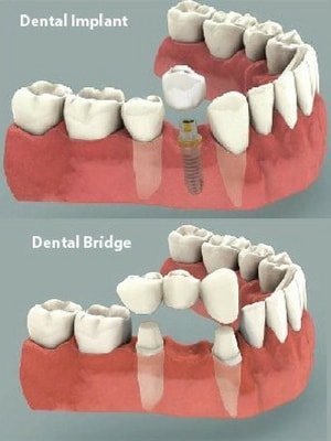 image of dental bridge versus dental implant