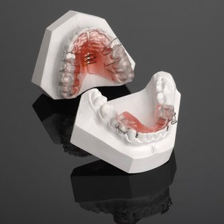 orthodontic plates children's dentistry