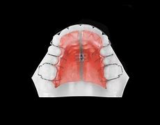 orthodontics plate for kids