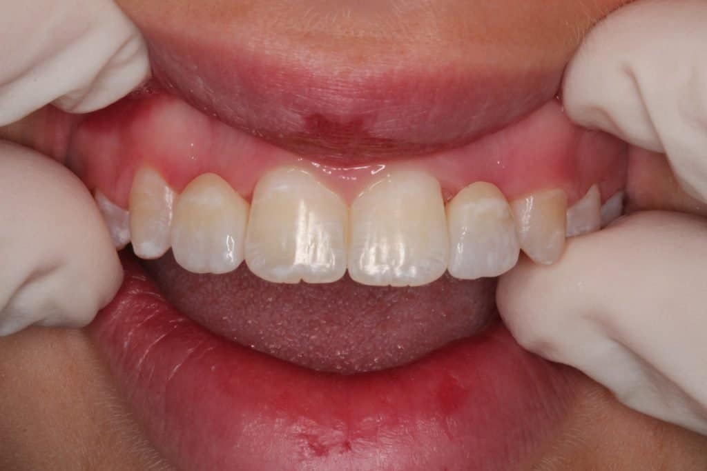 After dental crowns photo
