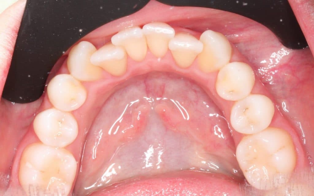 before orthodontics photo