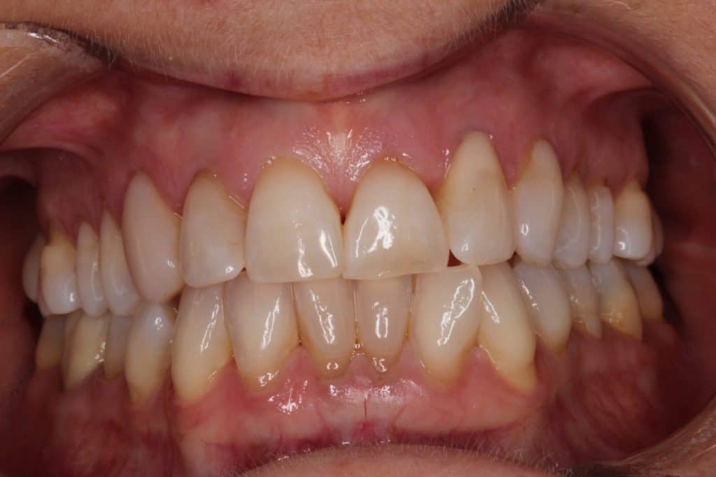 before dental veneers