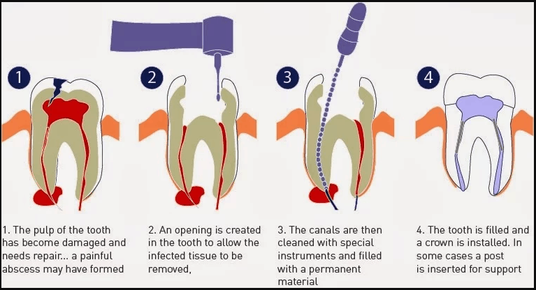 diagram of root canal therapy